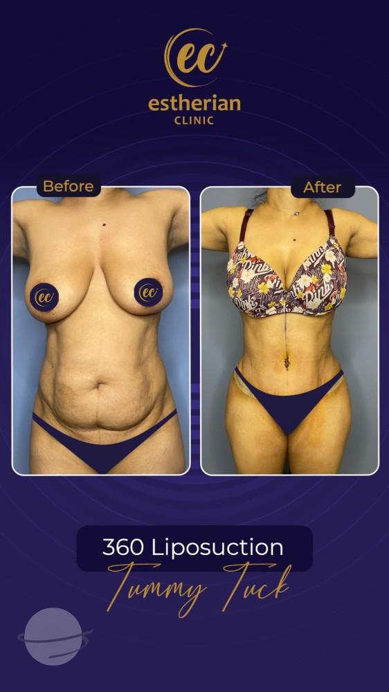Resultado de antes y después para Cirugía estética posparto — Estherian clinic