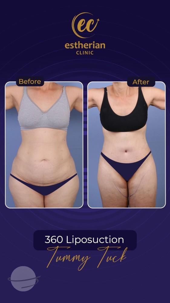 Risultato prima e dopo per Mommy Makeover — Estherian clinic