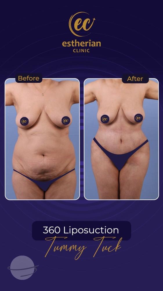 Risultato prima e dopo per Mommy Makeover — Estherian clinic