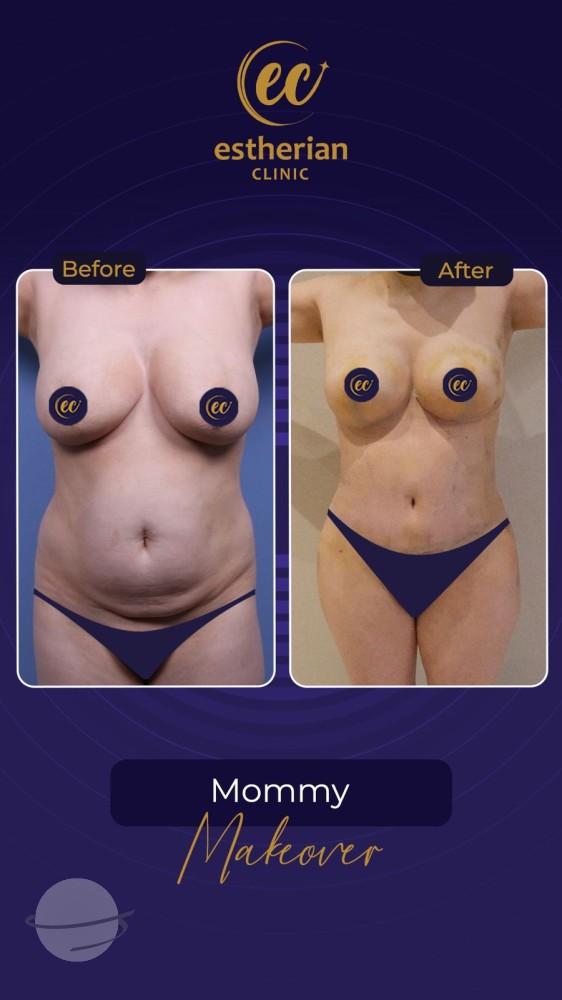 Risultato prima e dopo per Mommy Makeover — Estherian clinic