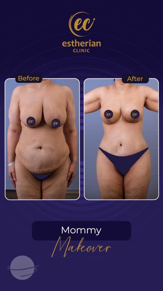 Risultato prima e dopo per Mommy Makeover — Estherian clinic
