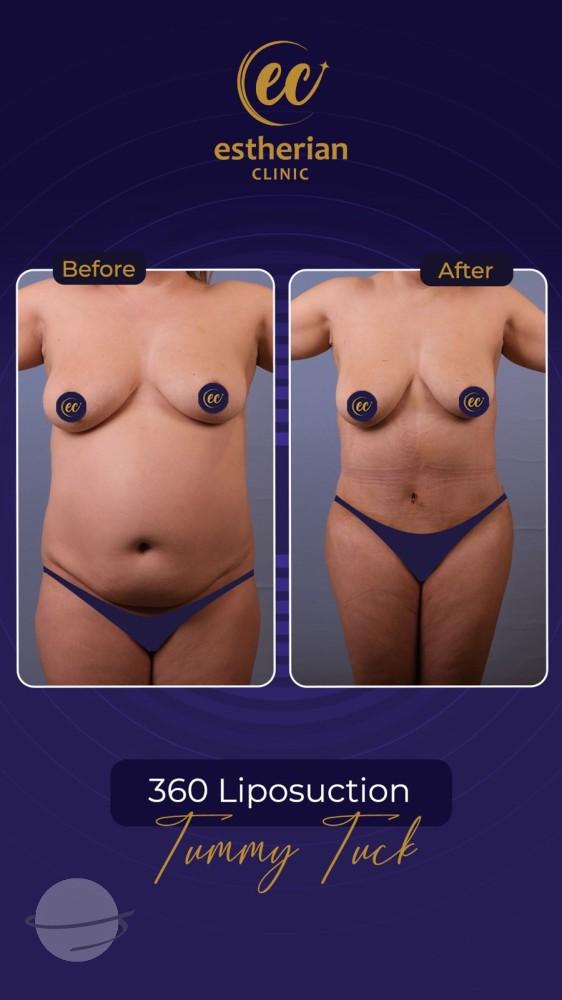 Risultato prima e dopo per Mommy Makeover — Estherian clinic