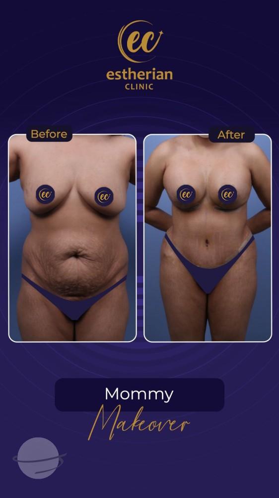 Risultato prima e dopo per Mommy Makeover — Estherian clinic