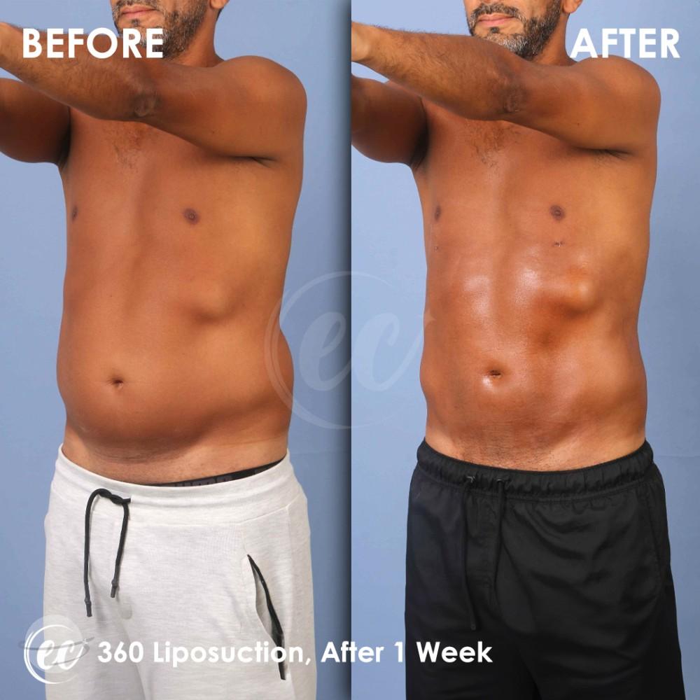 Risultato prima e dopo per Liposuzione — Estherian clinic