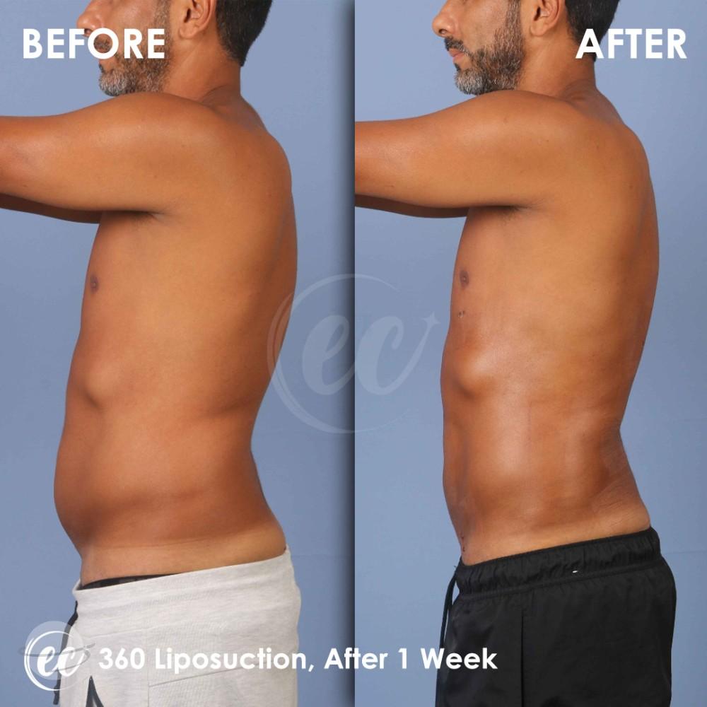 Risultato prima e dopo per Liposuzione — Estherian clinic