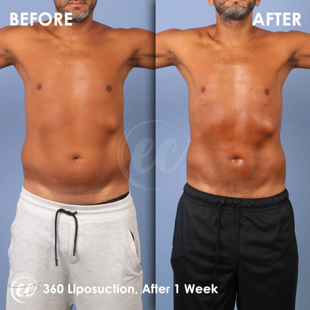 Risultato prima e dopo per Liposuzione — Estherian clinic