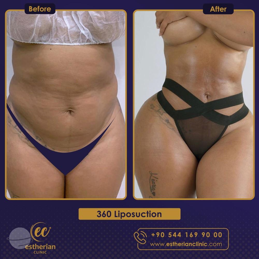 Risultato prima e dopo per Liposuzione — Estherian clinic