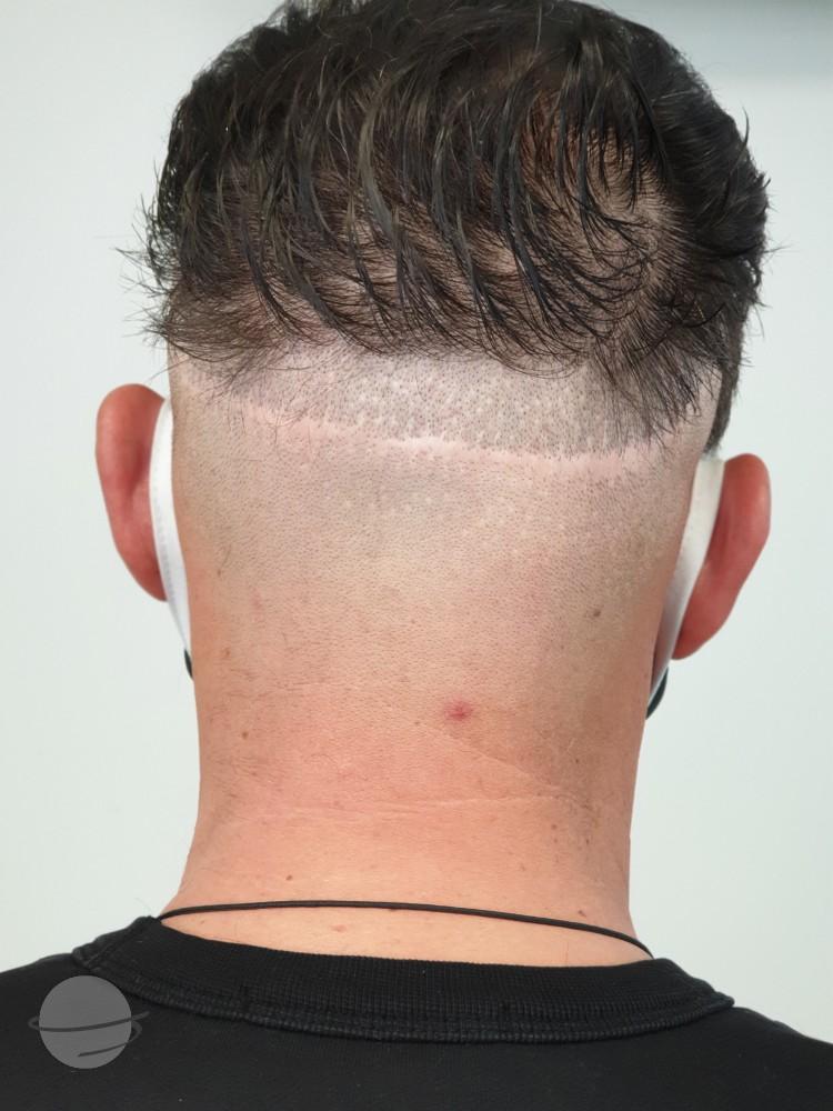 Risultato prima e dopo per Scalp Micro Pigmentation — Scalp Esthetik