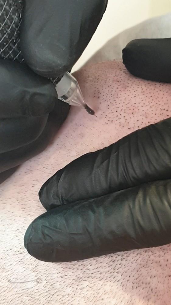 Scalp Micro Pigmentation result