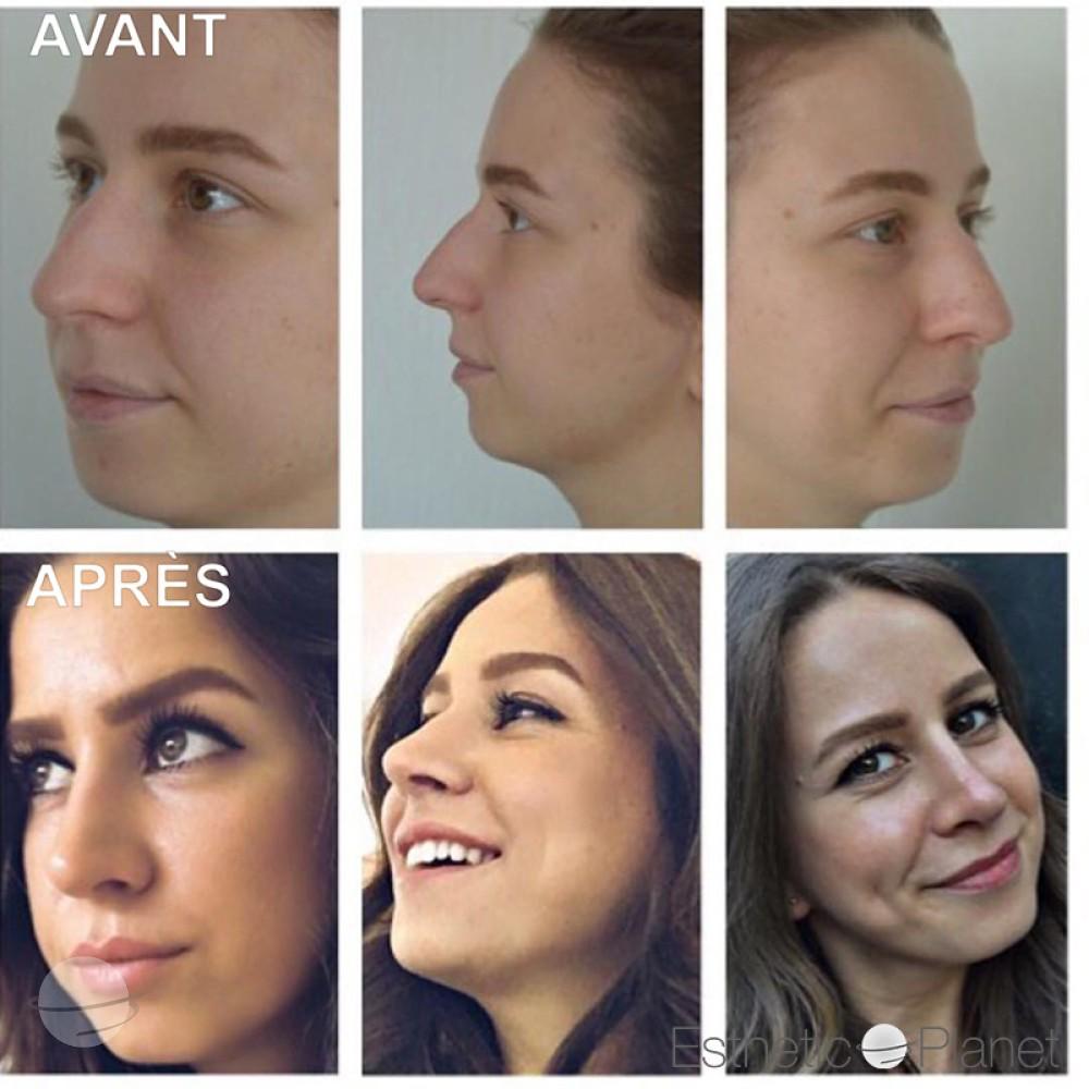 Rhinoplastie by Dr Ergin Er