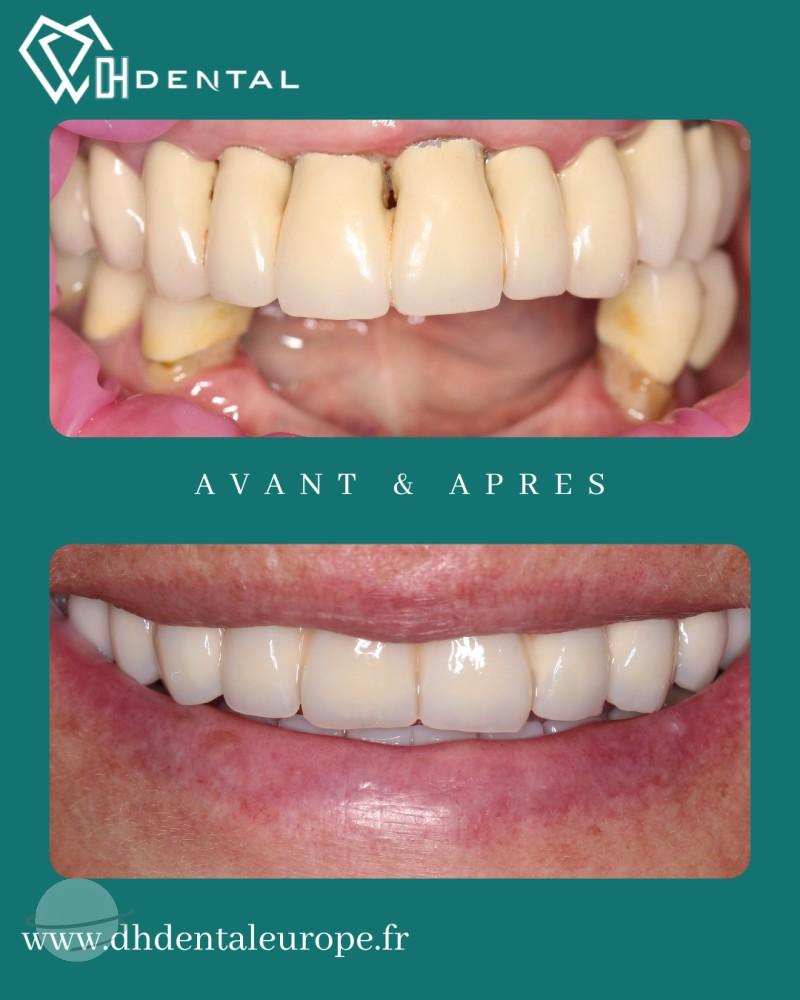 All-on-4 en haut et en bas