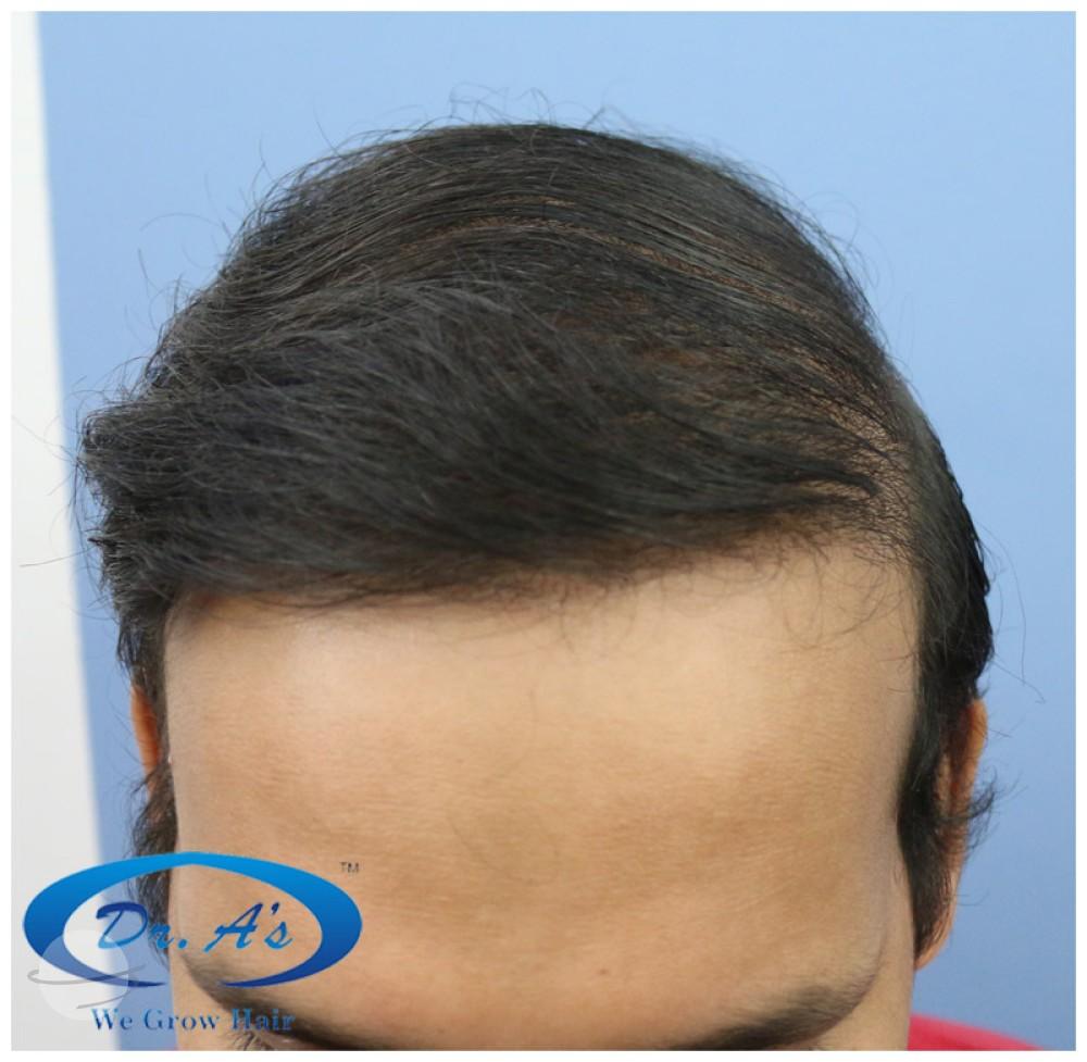 After picture 512_02