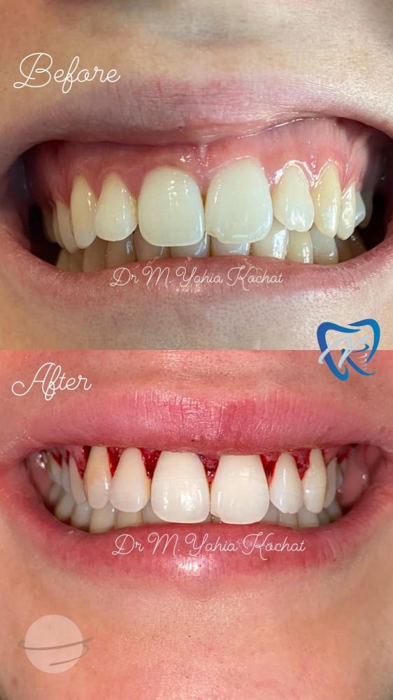 Elongation coronaire