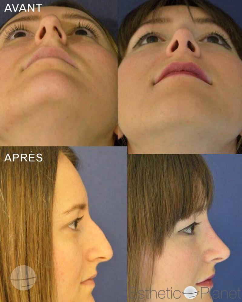 Rhinoplastie by Dr Ergin Er