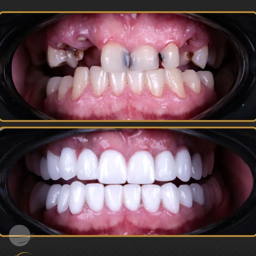 Risultato prima e dopo per Faccette dentali — Estherian clinic