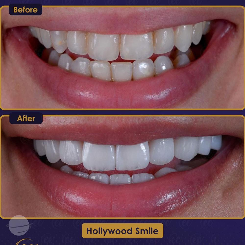 Risultato prima e dopo per Faccette dentali — Estherian clinic