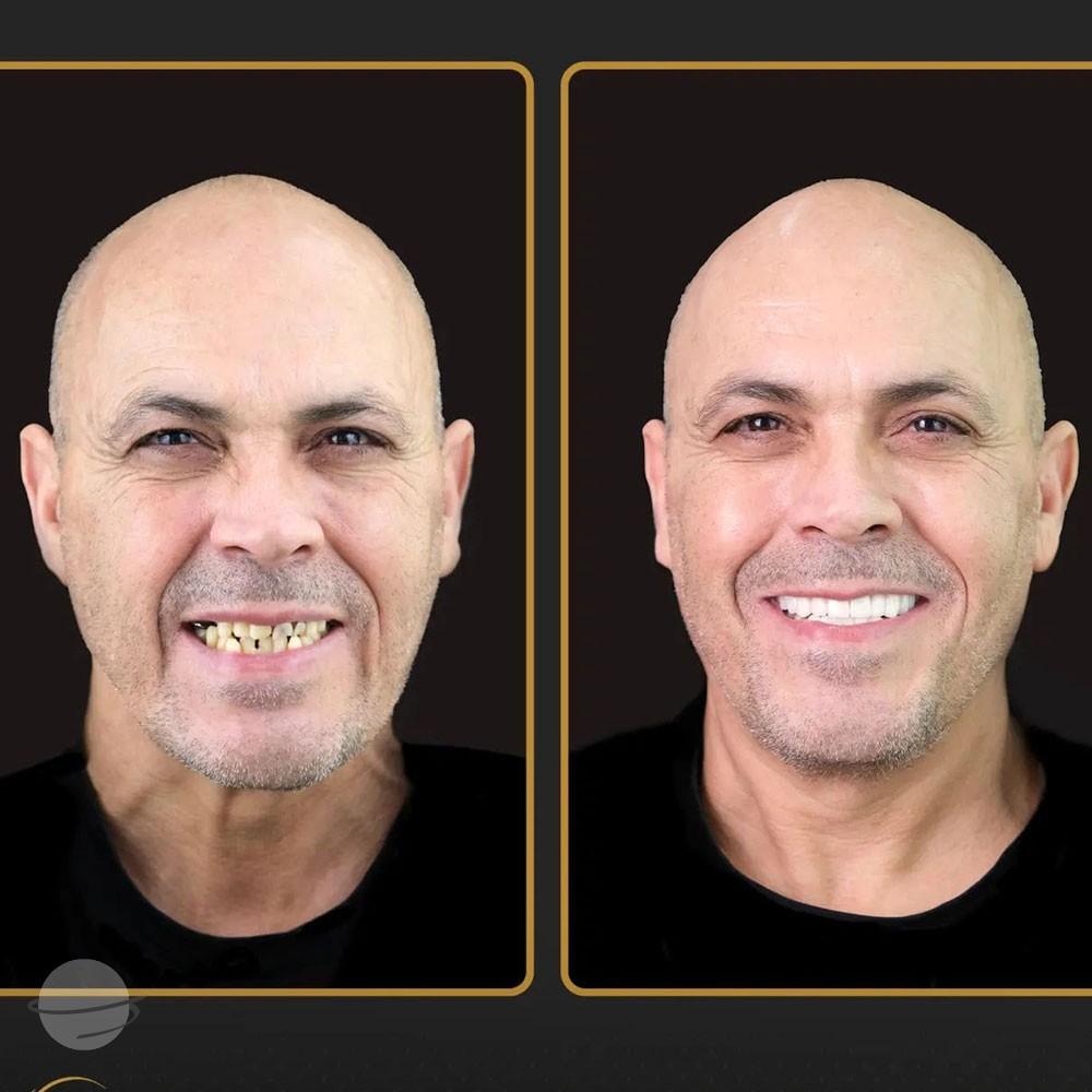Risultato prima e dopo per Faccette dentali — Estherian clinic