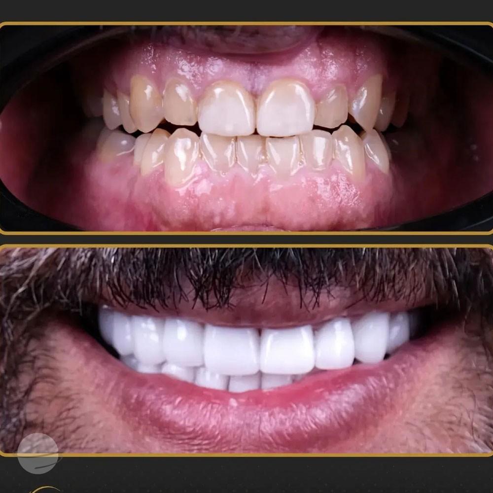 Resultado de antes y después para Coronas dentales — Estherian clinic