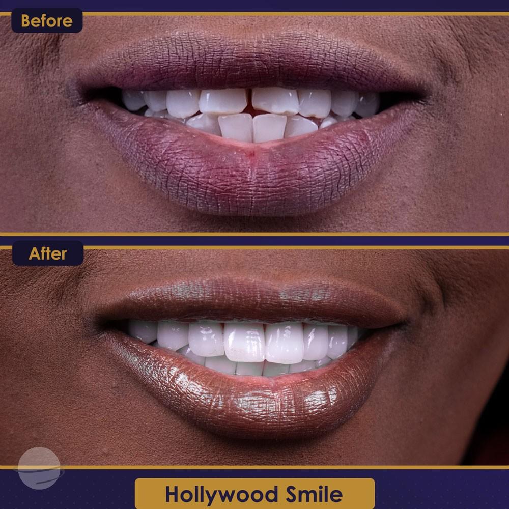 Resultado de antes y después para Coronas dentales — Estherian clinic