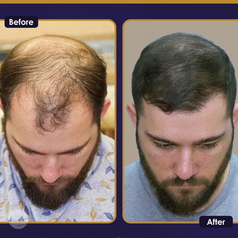 Resultado de antes y después para DHI — Estherian clinic