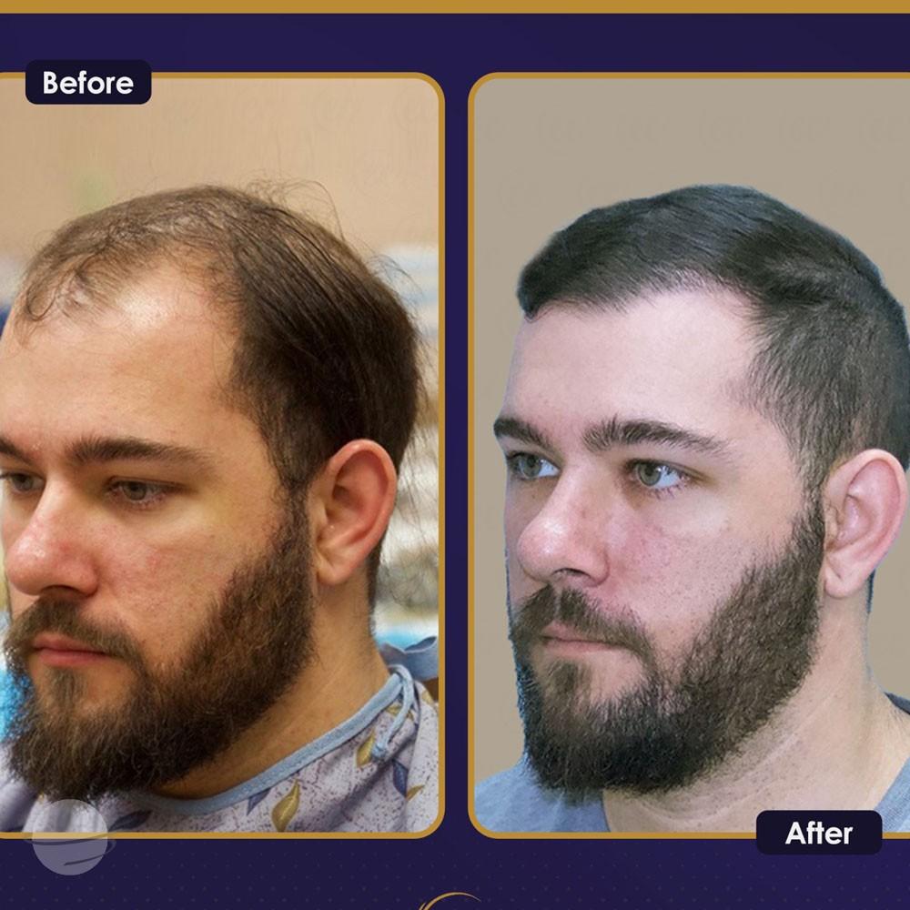 Resultado de antes y después para DHI — Estherian clinic