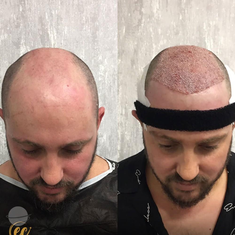 Resultado de antes y después para DHI — Estherian clinic