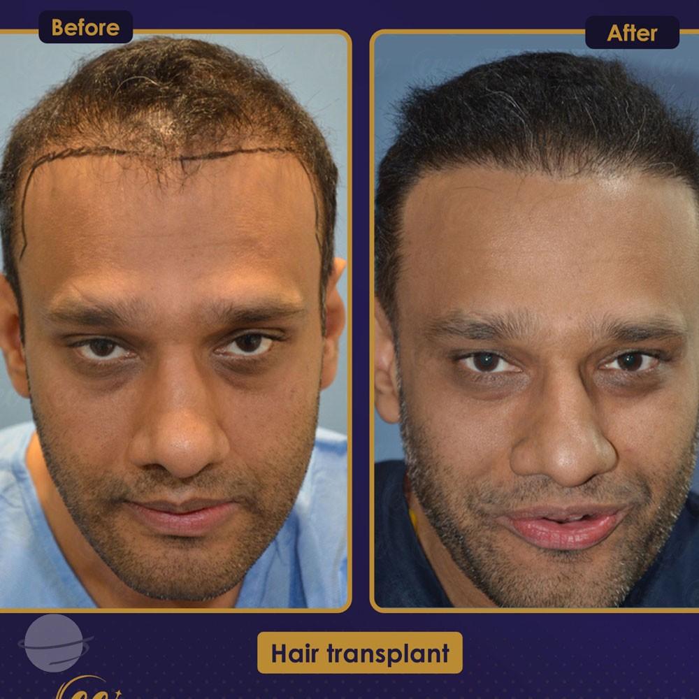 Resultado de antes y después para DHI — Estherian clinic