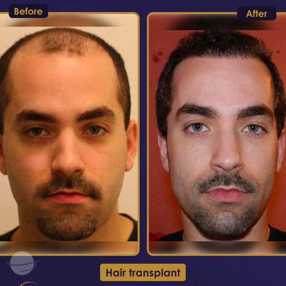 Resultado de antes y después para DHI — Estherian clinic