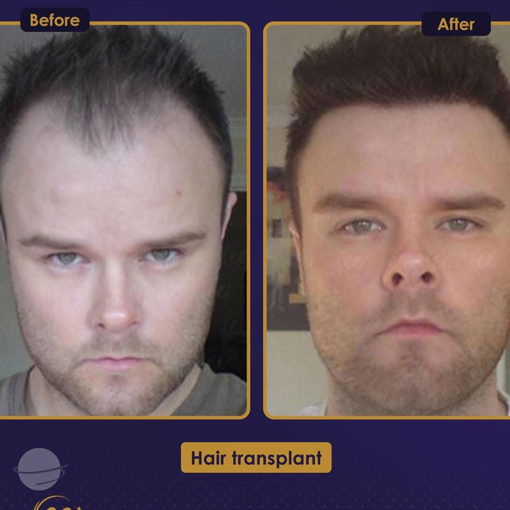 Before and after result for DHI — Estherian clinic