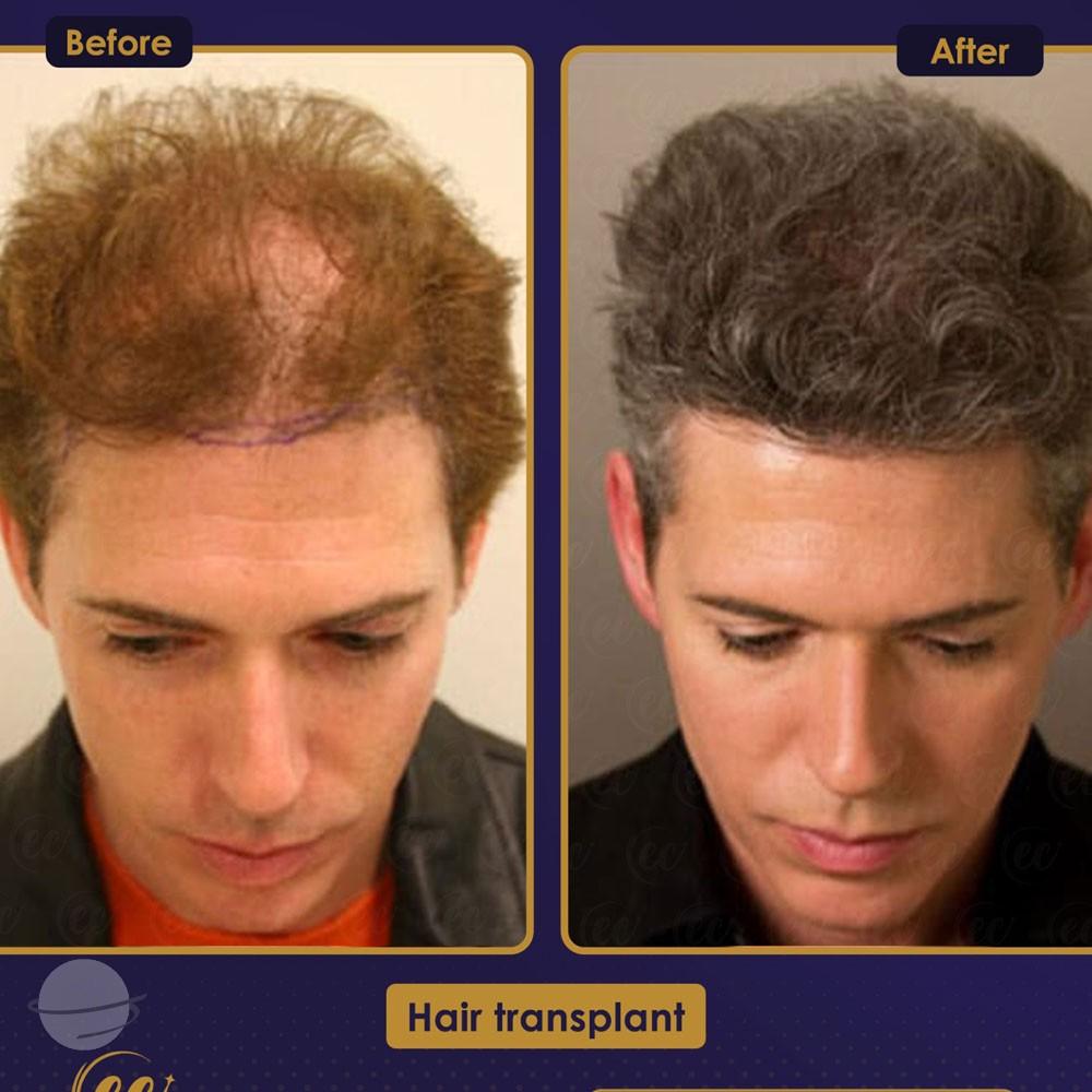 Resultado de antes y después para DHI — Estherian clinic