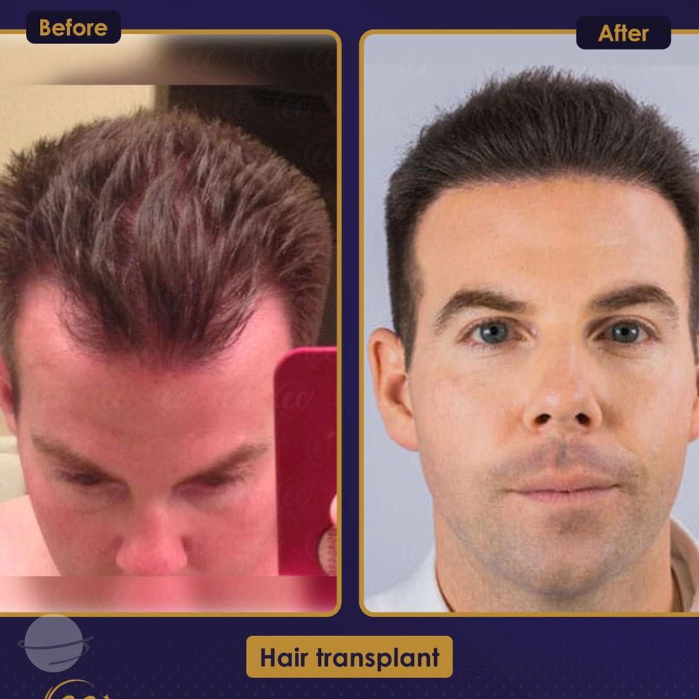 Resultado de antes y después para DHI — Estherian clinic