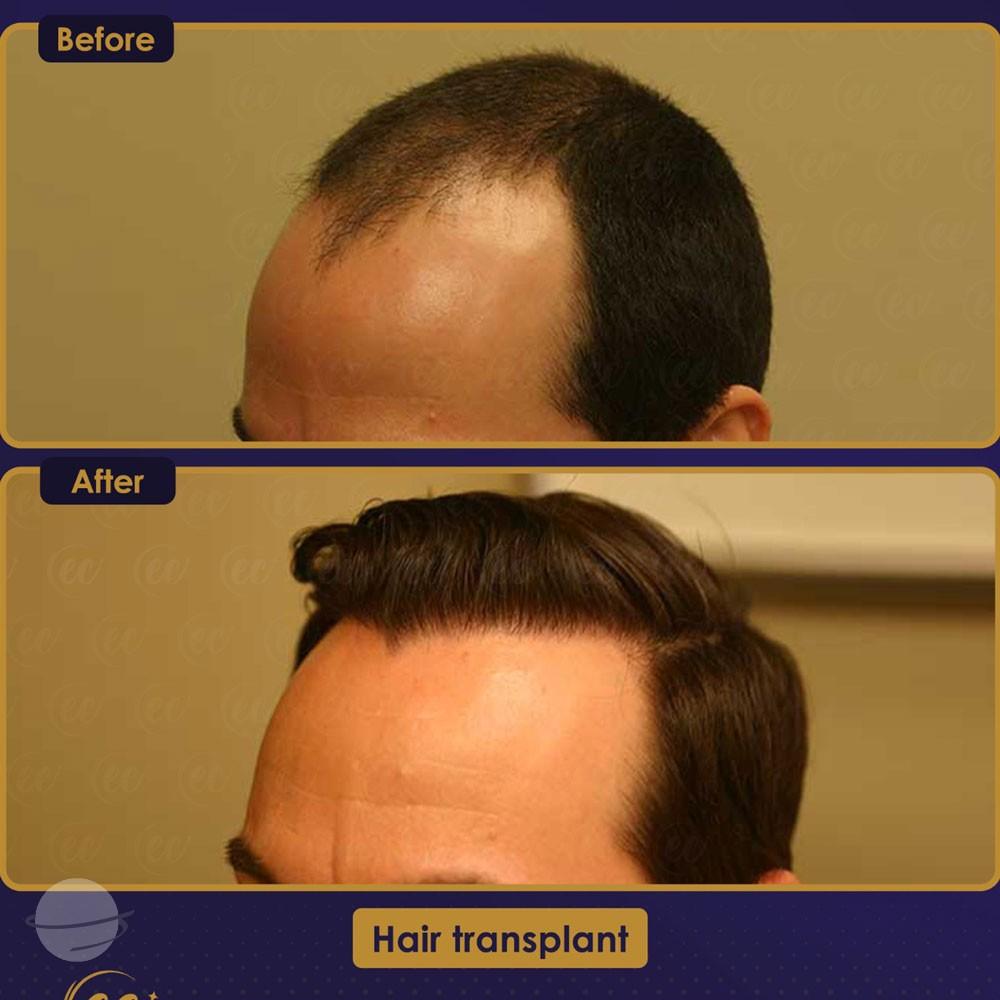 Resultado de antes y después para DHI — Estherian clinic