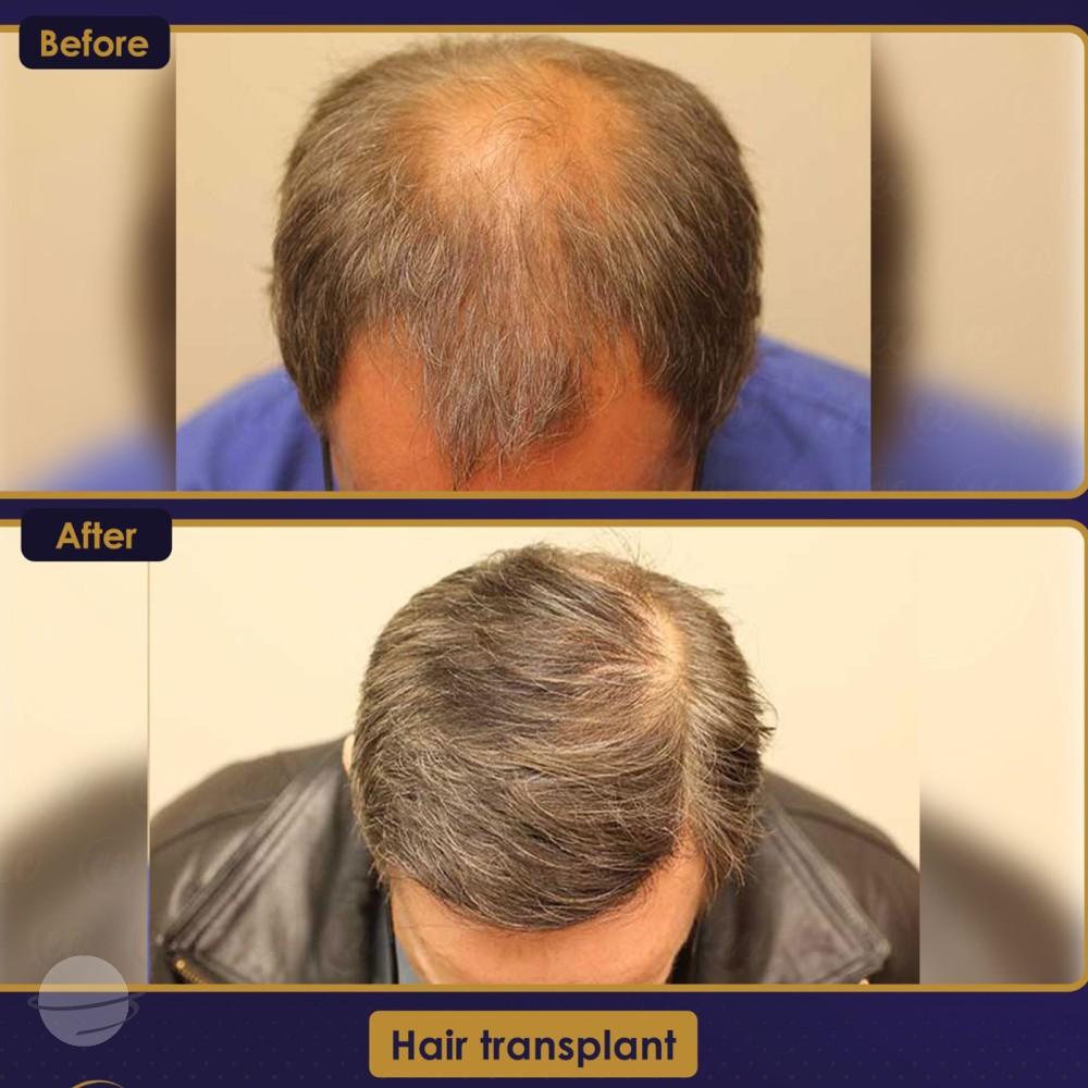 Before and after result for DHI — Estherian clinic