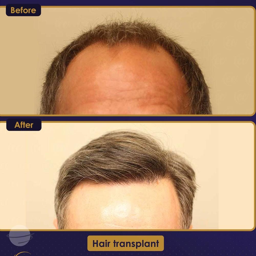 Before and after result for FUE — Estherian clinic