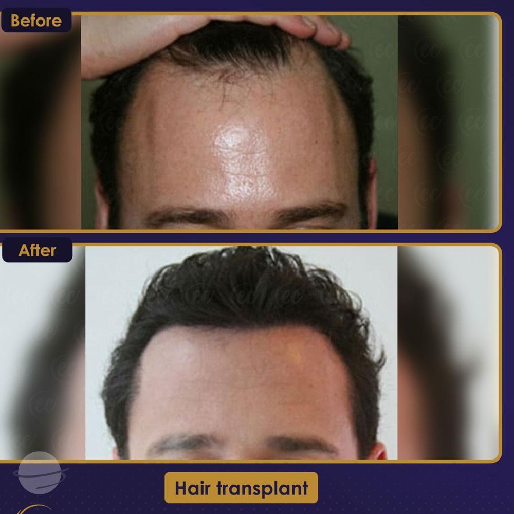 Before and after result for DHI — Estherian clinic