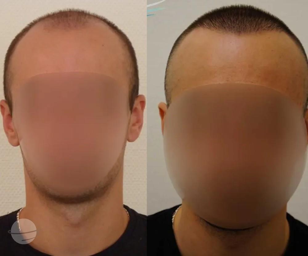Résultat avant / après pour FUE — Dr Beyhan Zeybek MD