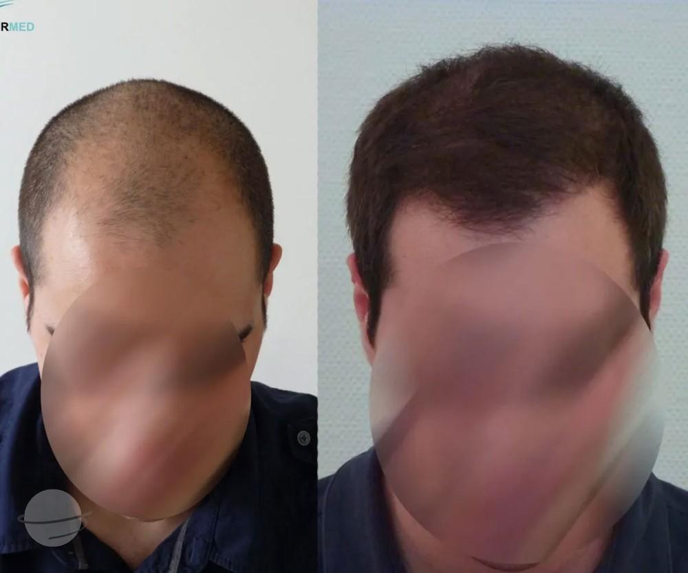 Résultat avant / après pour FUE — Dr Beyhan Zeybek MD