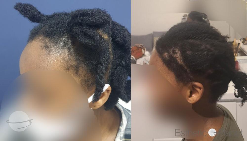 FUT AFRO HAIR FRONTAL HAIRLINE