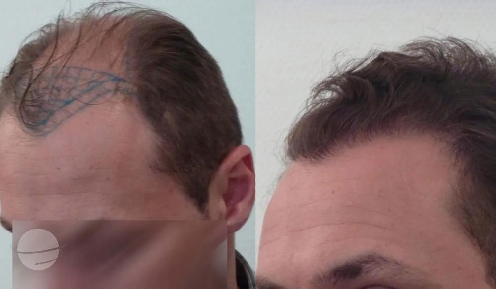 3000 FUT By Dr Beyhan Zeybek