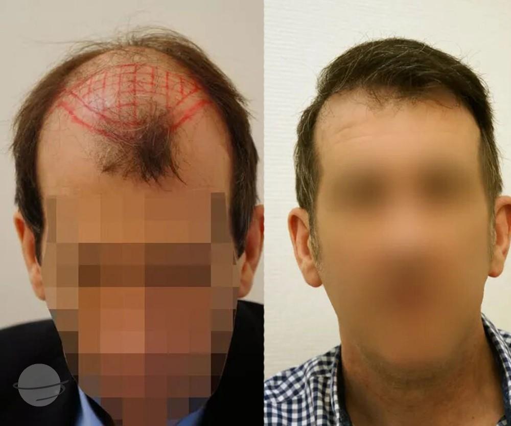 3800 FUT by Dr Beyhan