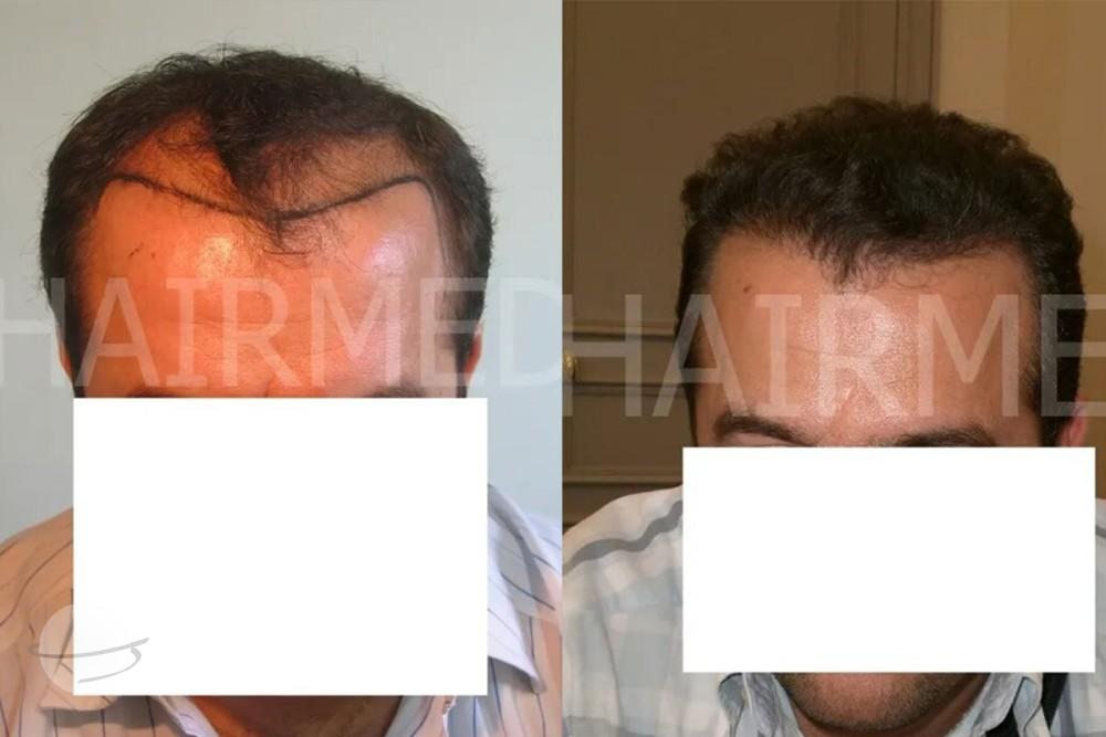 Résultat avant / après pour FUT — Dr Beyhan Zeybek MD