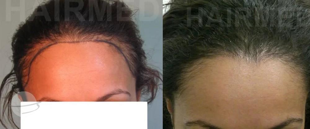 Before and after result for FUT — Dr Beyhan Zeybek Hair restoration expert