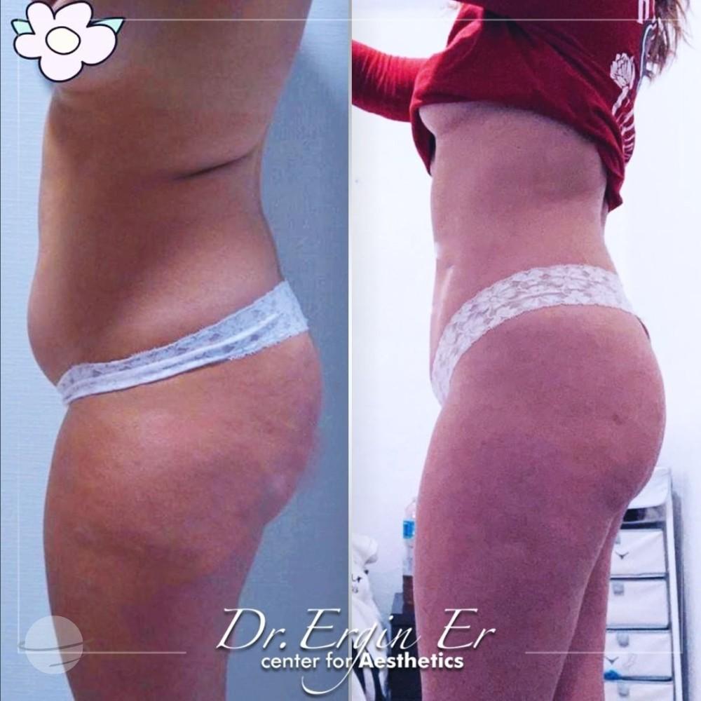 Risultato prima e dopo per Liposuzione — Dr Ergin Er's Clinic