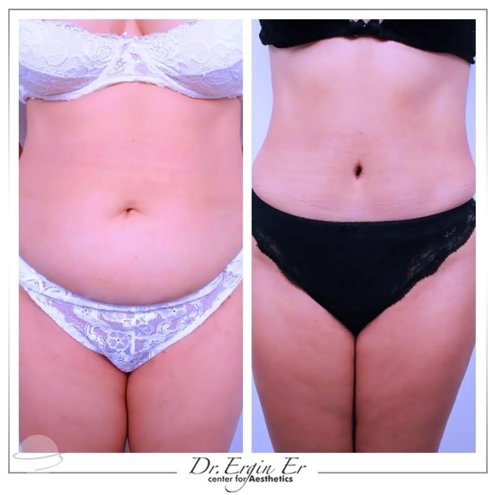 Resultado de antes y después para Liposucción — Dr Ergin Er Clinique Esthétique
