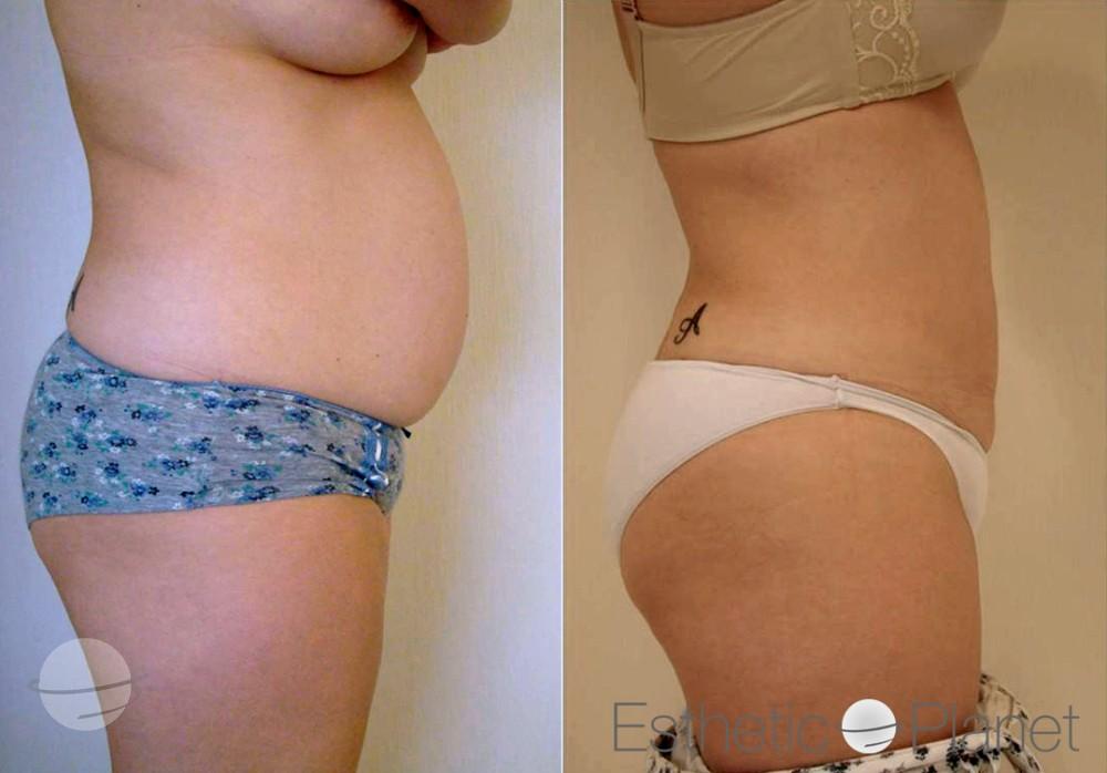 Risultato prima e dopo per Liposuzione — Dr Ergin Er's Clinic