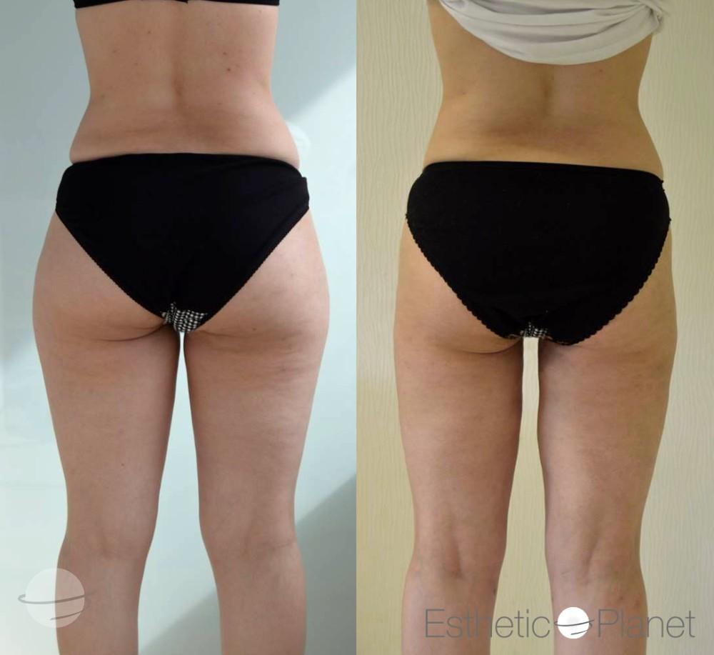 Risultato prima e dopo per Liposuzione — Dr Ergin Er's Clinic