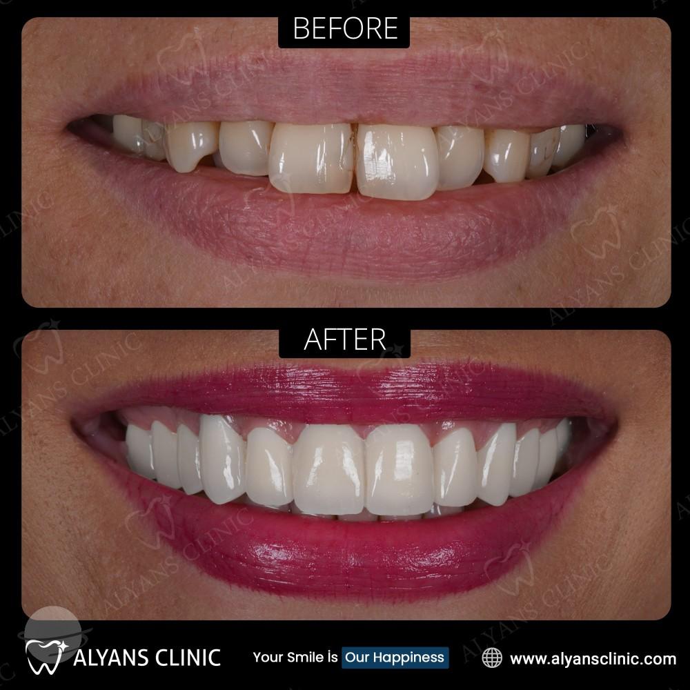Resultado de antes y después para Reconstrucción total — Alyans Clinic