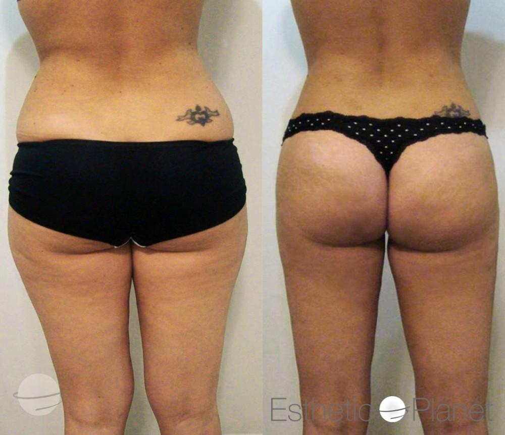 Risultato prima e dopo per Liposuzione — Dr Ergin Er's Clinic