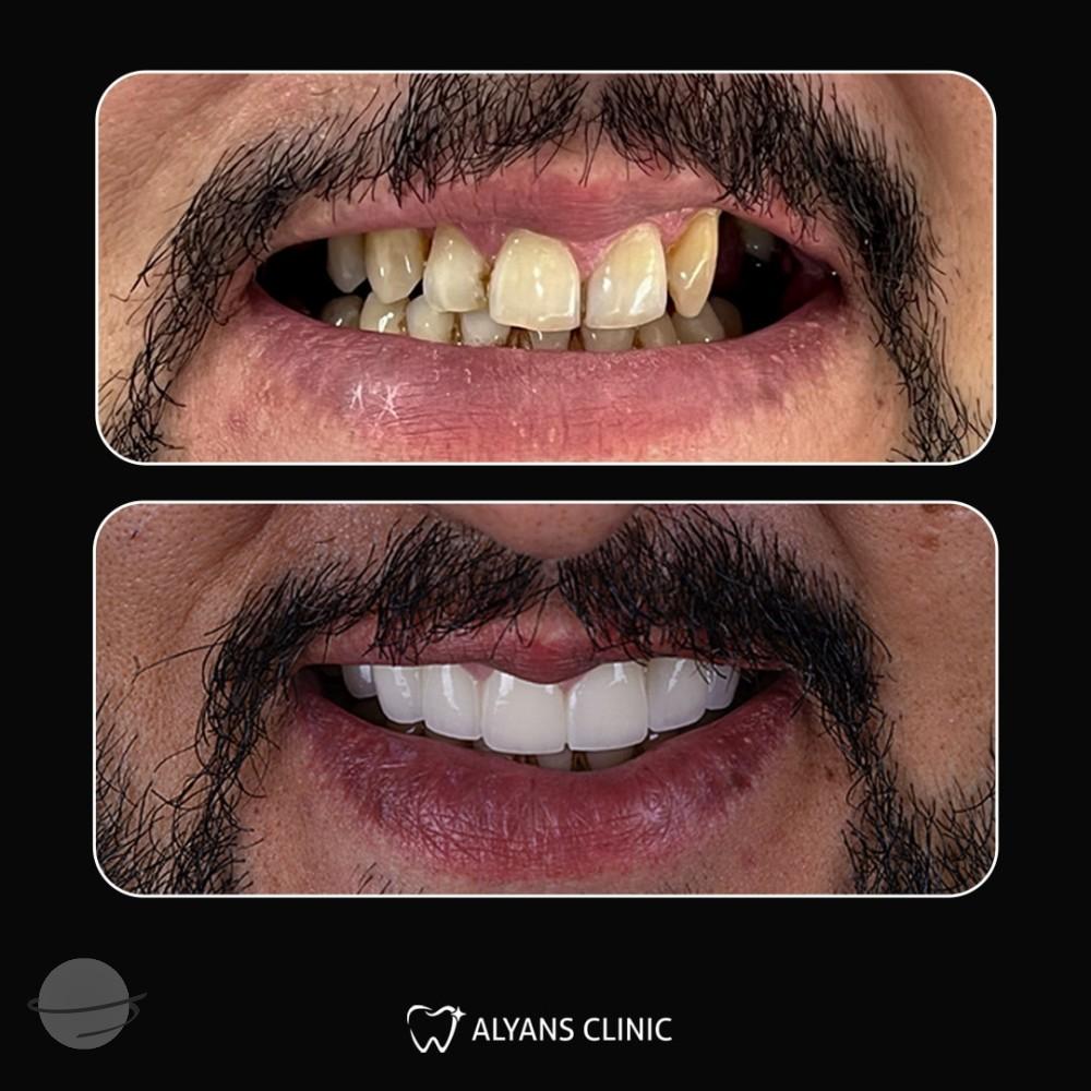 Risultato prima e dopo per Corone dentali — Alyans Clinic
