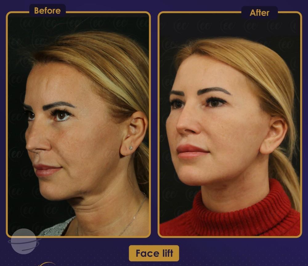 Résultat Estherian5